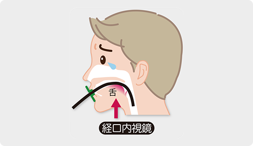 経口内視鏡