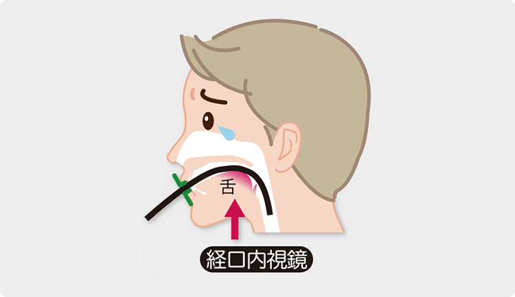 経口内視鏡